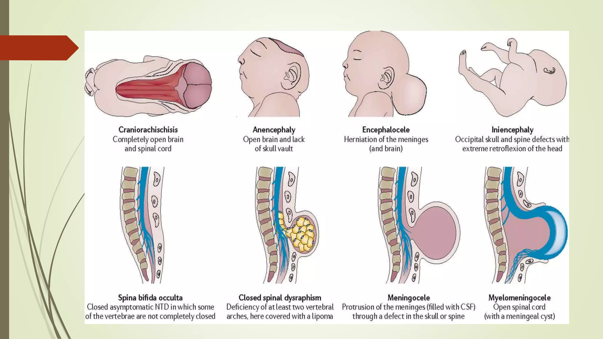 Neutral Defects Neural tube defects | PPTX