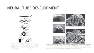Neural Tube Defects in children - paediatric surgeon | PPTX