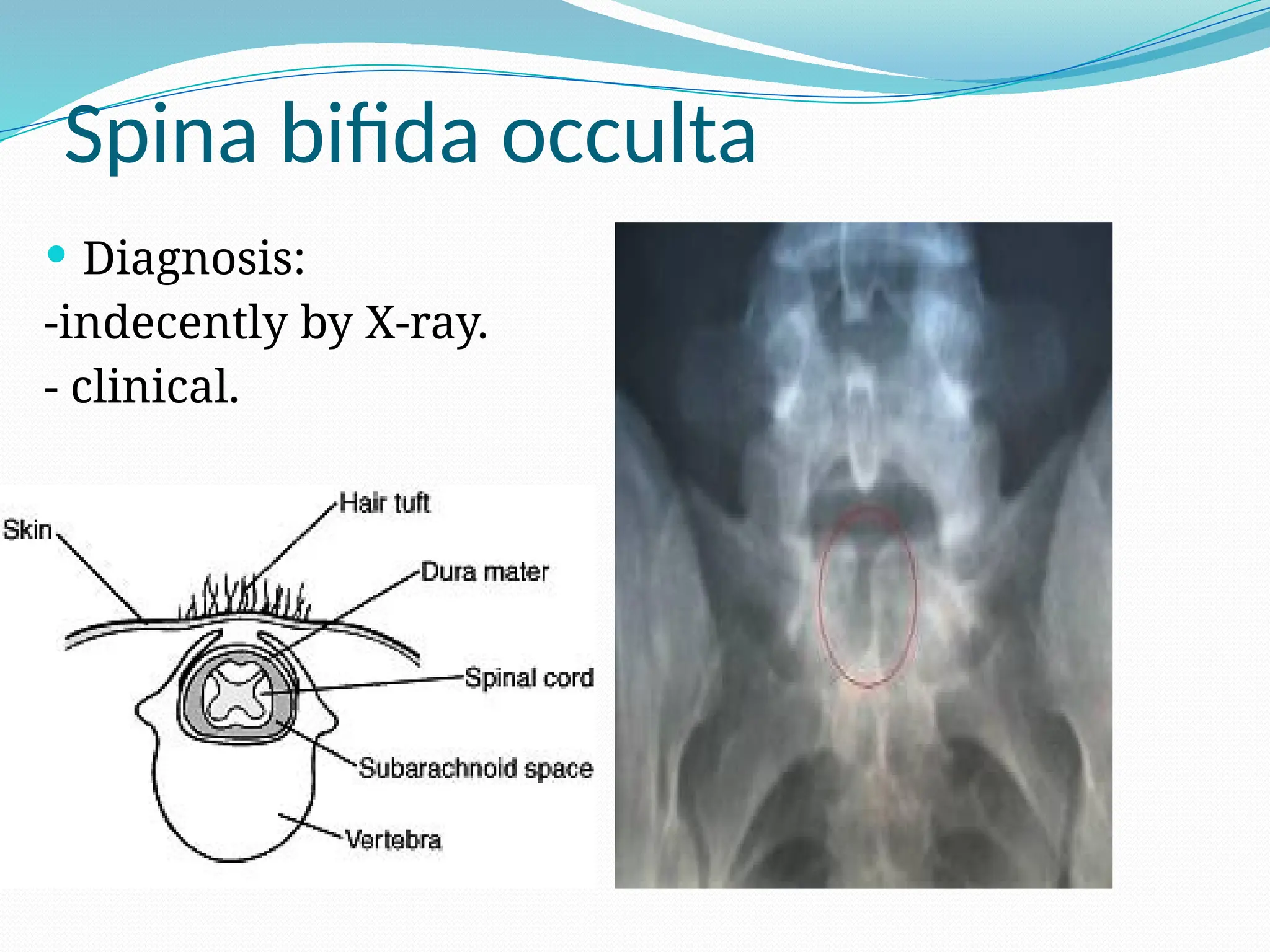 Spina bifida occulta
 Diagnosis:
-indecently by X-ray.
- clinical.
 