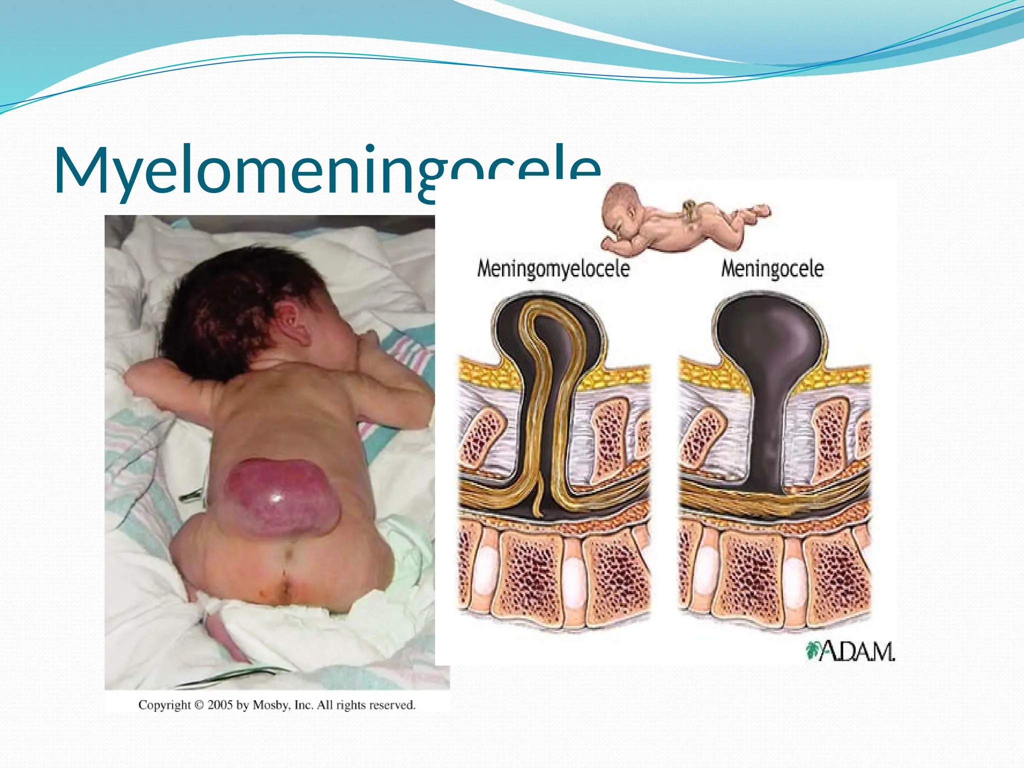 Myelomeningocele
 