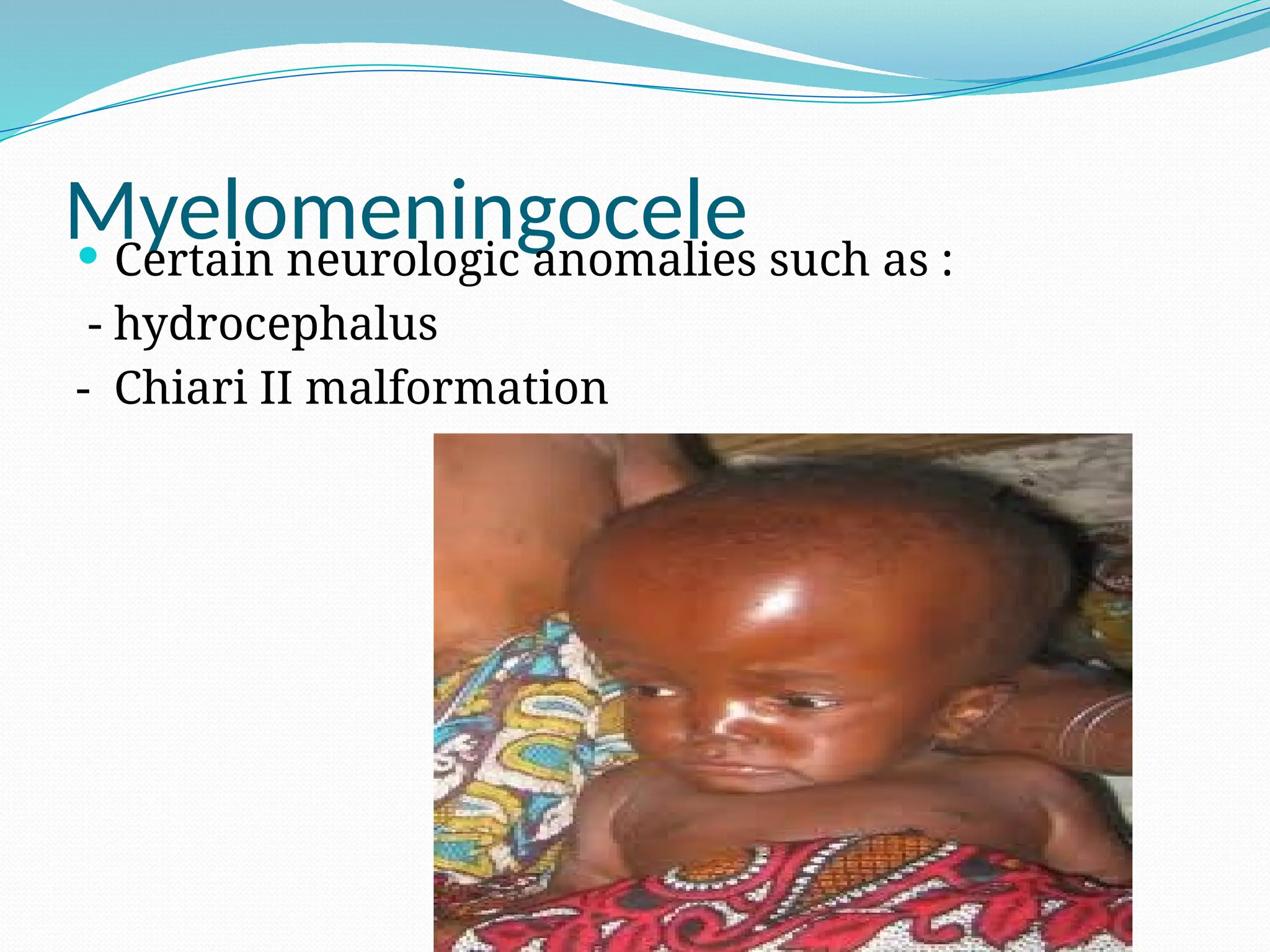 Myelomeningocele
 Certain neurologic anomalies such as :
- hydrocephalus
- Chiari II malformation
 