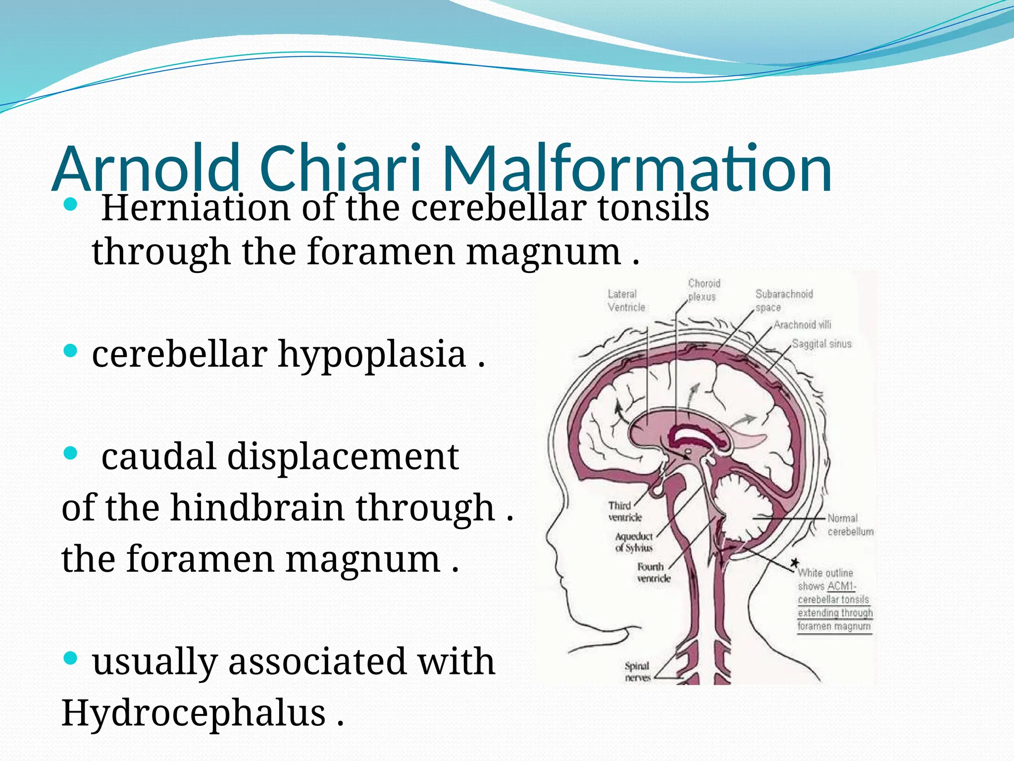 Arnold Chiari Malformation
 Herniation of the cerebellar tonsils
through the foramen magnum .
 cerebellar hypoplasia .
 caudal displacement
of the hindbrain through .
the foramen magnum .
 usually associated with
Hydrocephalus .
 