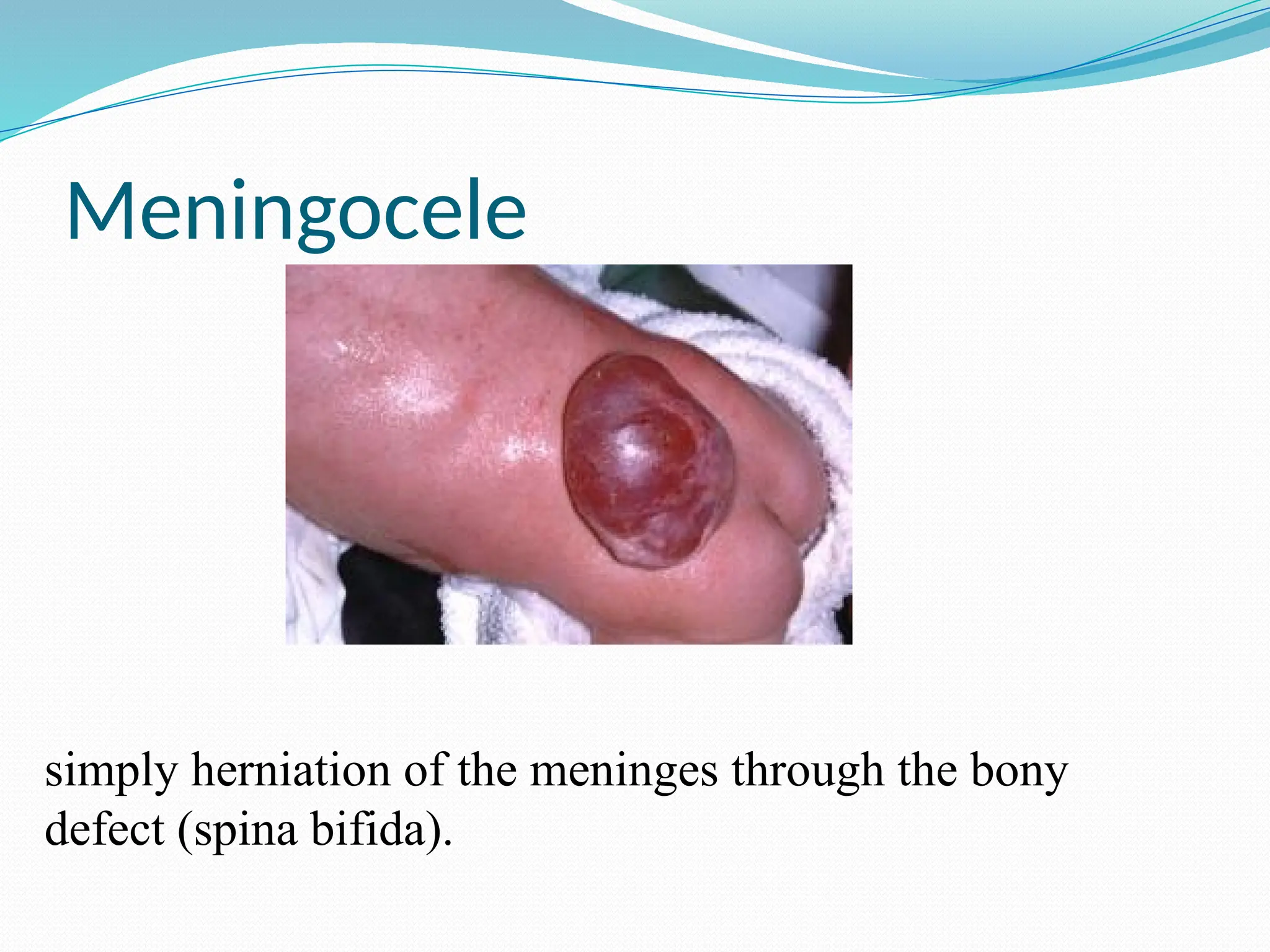 Meningocele
simply herniation of the meninges through the bony
defect (spina bifida).
 