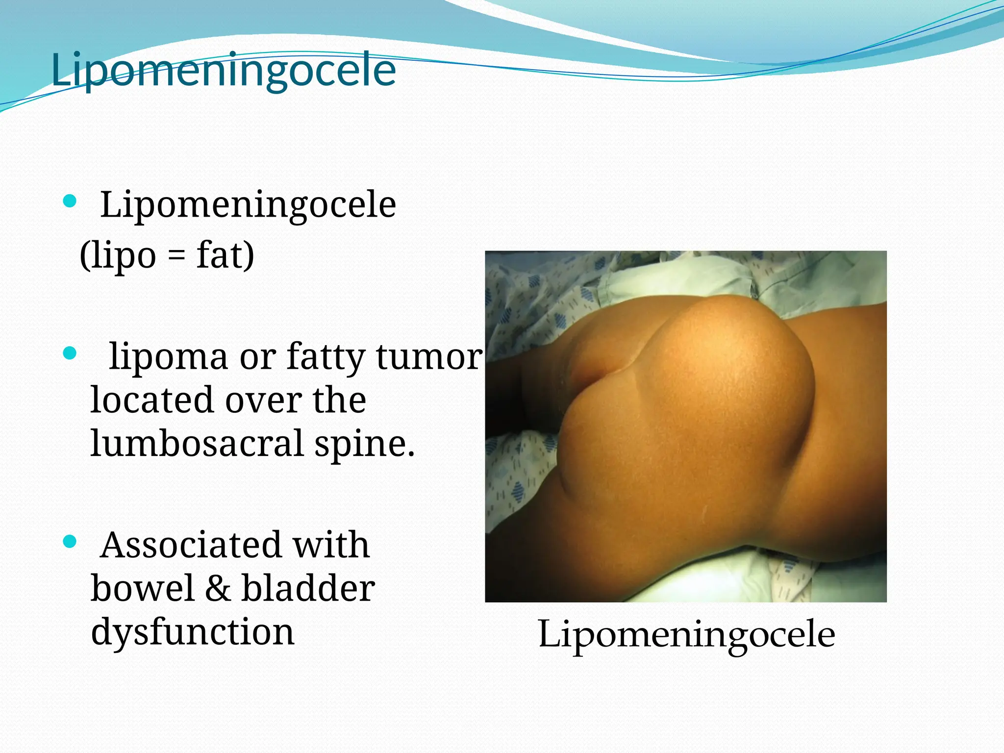 Lipomeningocele
 Lipomeningocele
(lipo = fat)
 lipoma or fatty tumor
located over the
lumbosacral spine.
 Associated with
bowel & bladder
dysfunction Lipomeningocele
 