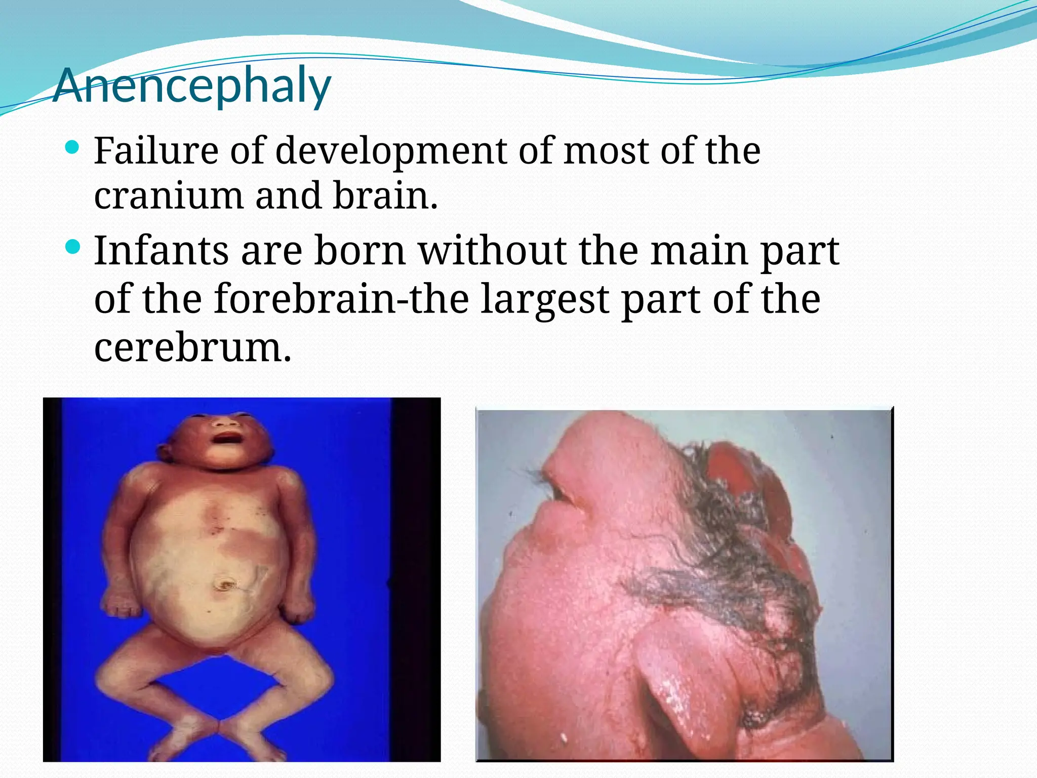 Anencephaly
 Failure of development of most of the
cranium and brain.
 Infants are born without the main part
of the forebrain-the largest part of the
cerebrum.
 