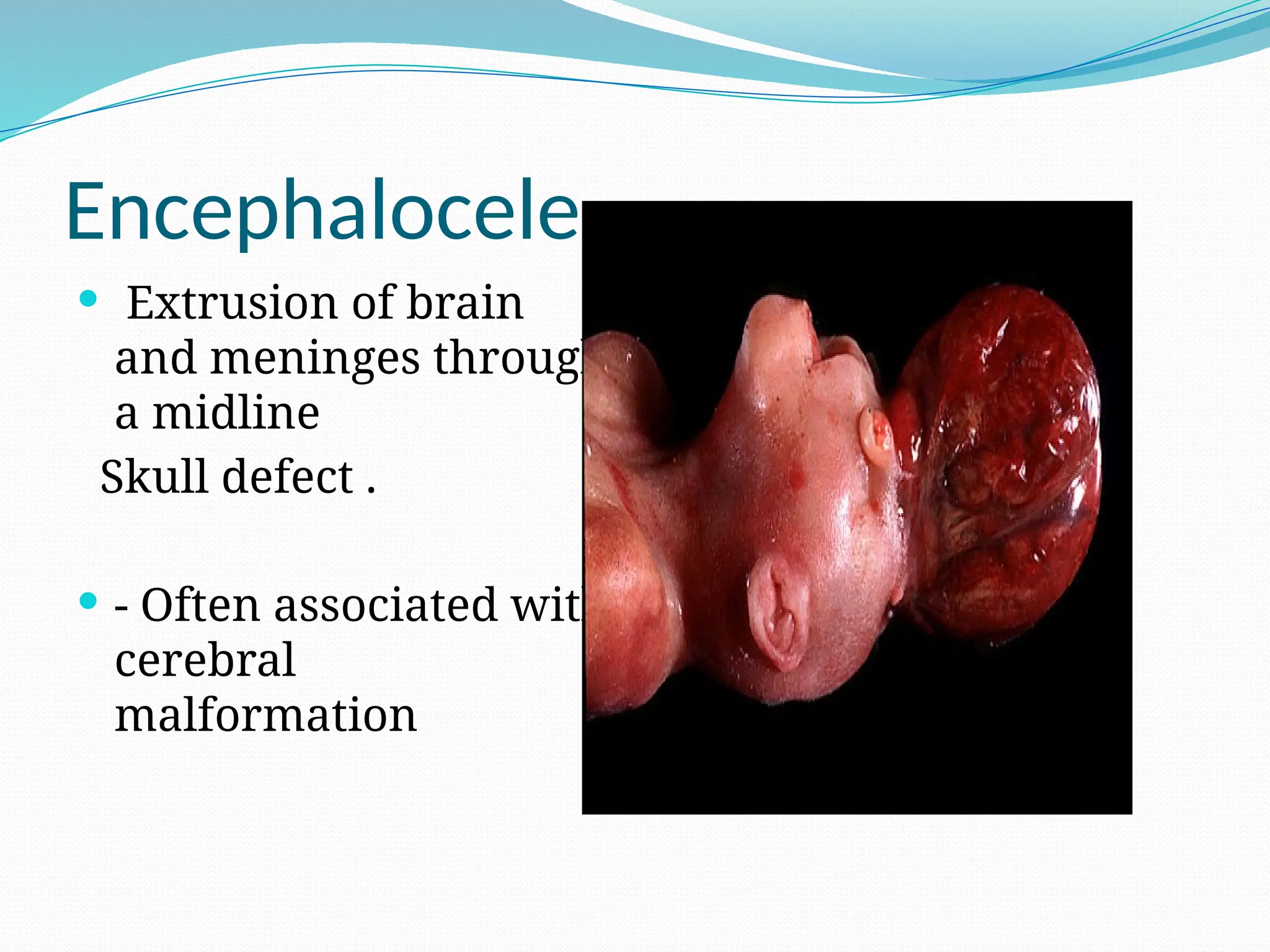 Encephalocele
 Extrusion of brain
and meninges through
a midline
Skull defect .
 - Often associated with
cerebral
malformation
 