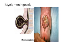 Myelomeningocele
 