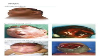 Anencephaly
 