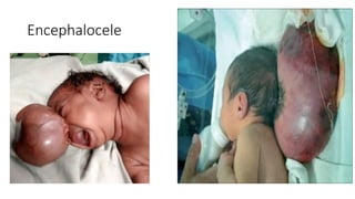 Encephalocele
 