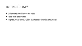 INIENCEPHALY
• Extreme retroflexion of the head
• Head bent backwards
• Might survive for few years but has low chances of survival
 