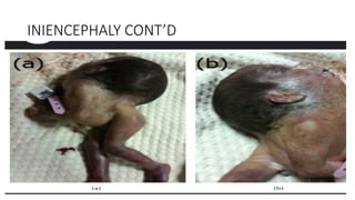 INIENCEPHALY CONT’D
 