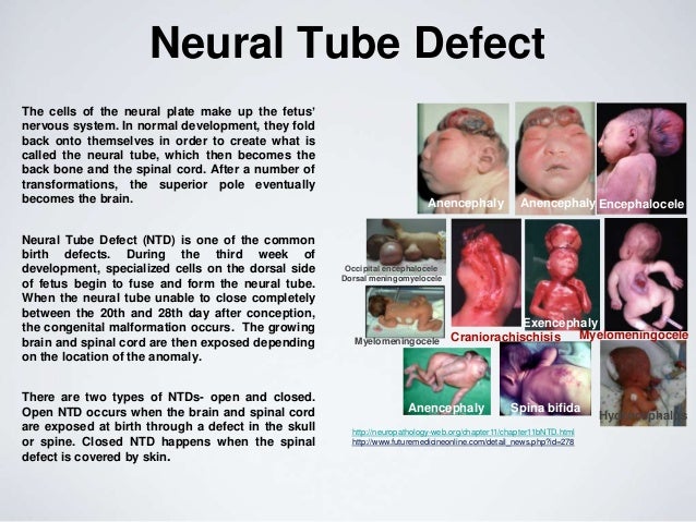 neural tube defect