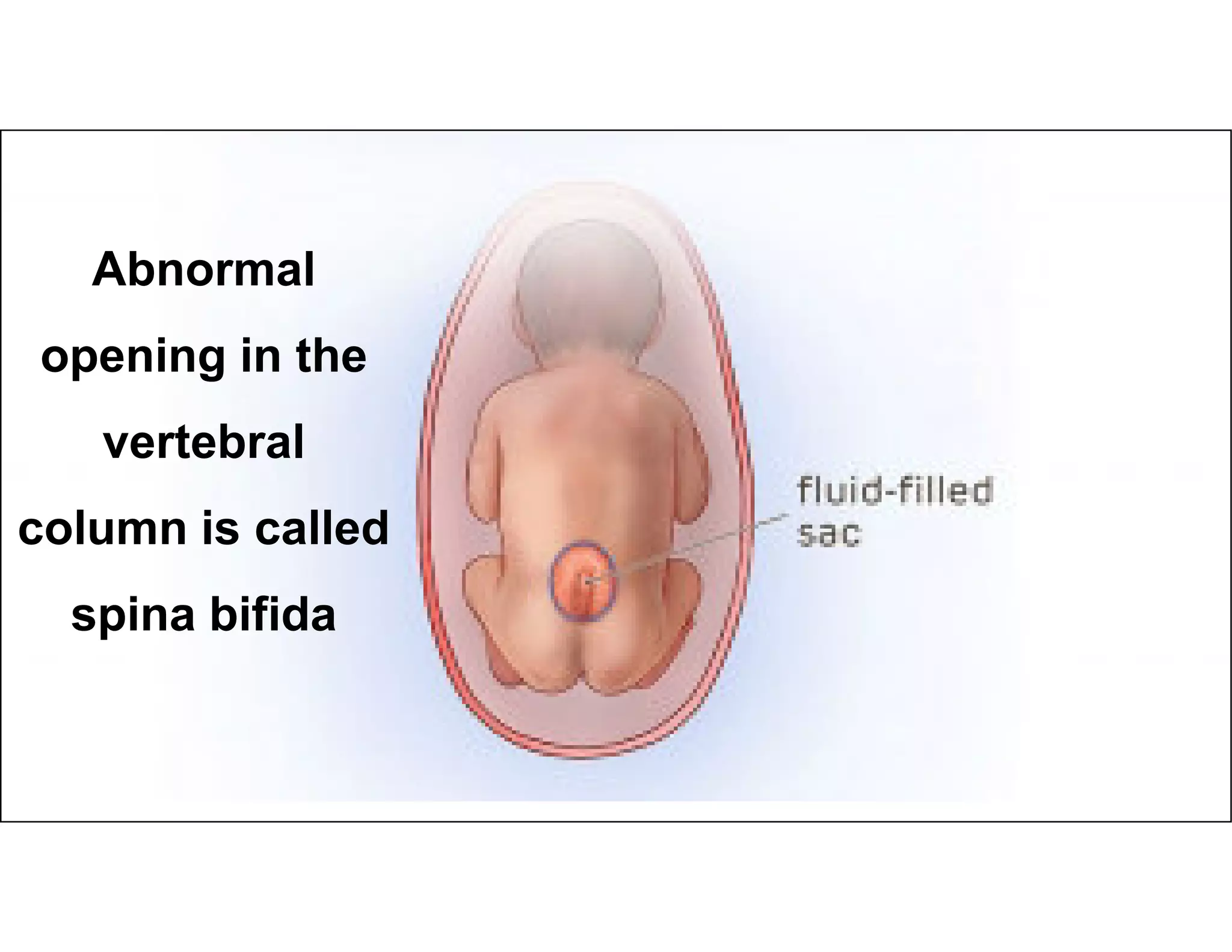 Neural tube defects and the role of folic acid in Lowering the Risk.pdf