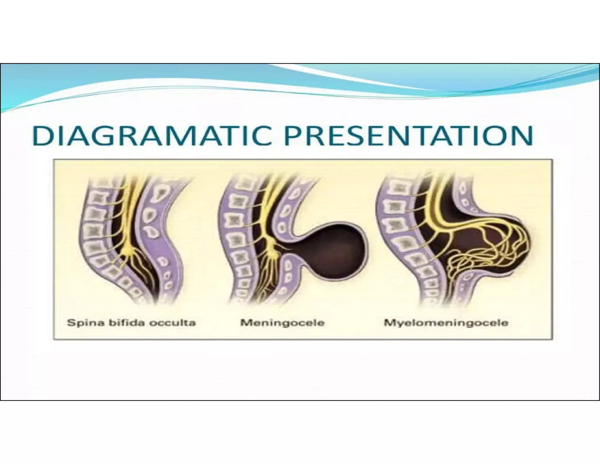 Neural tube defects and the role of folic acid in Lowering the Risk.pdf