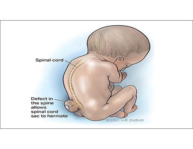 Neural tube defects and the role of folic acid in Lowering the Risk.pdf ...