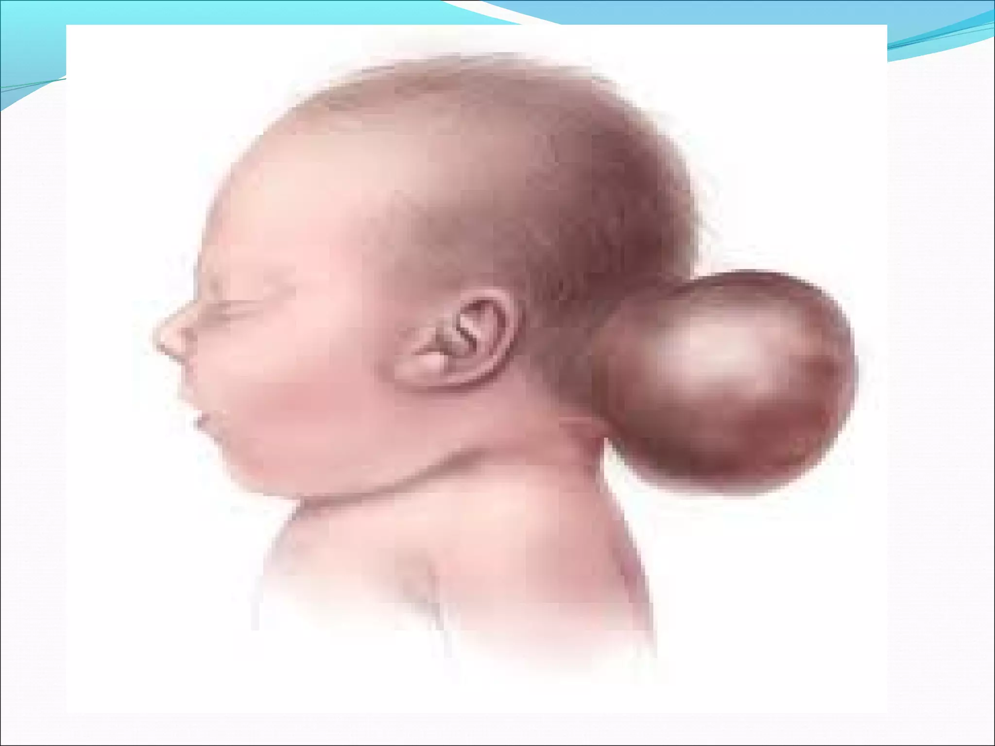 Netural Defect Neural tube defects | PPT