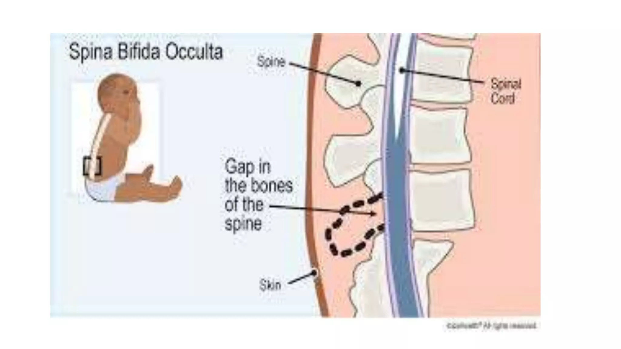 Neural tube defects (myelomeningocele) | spina bifida | PPTX