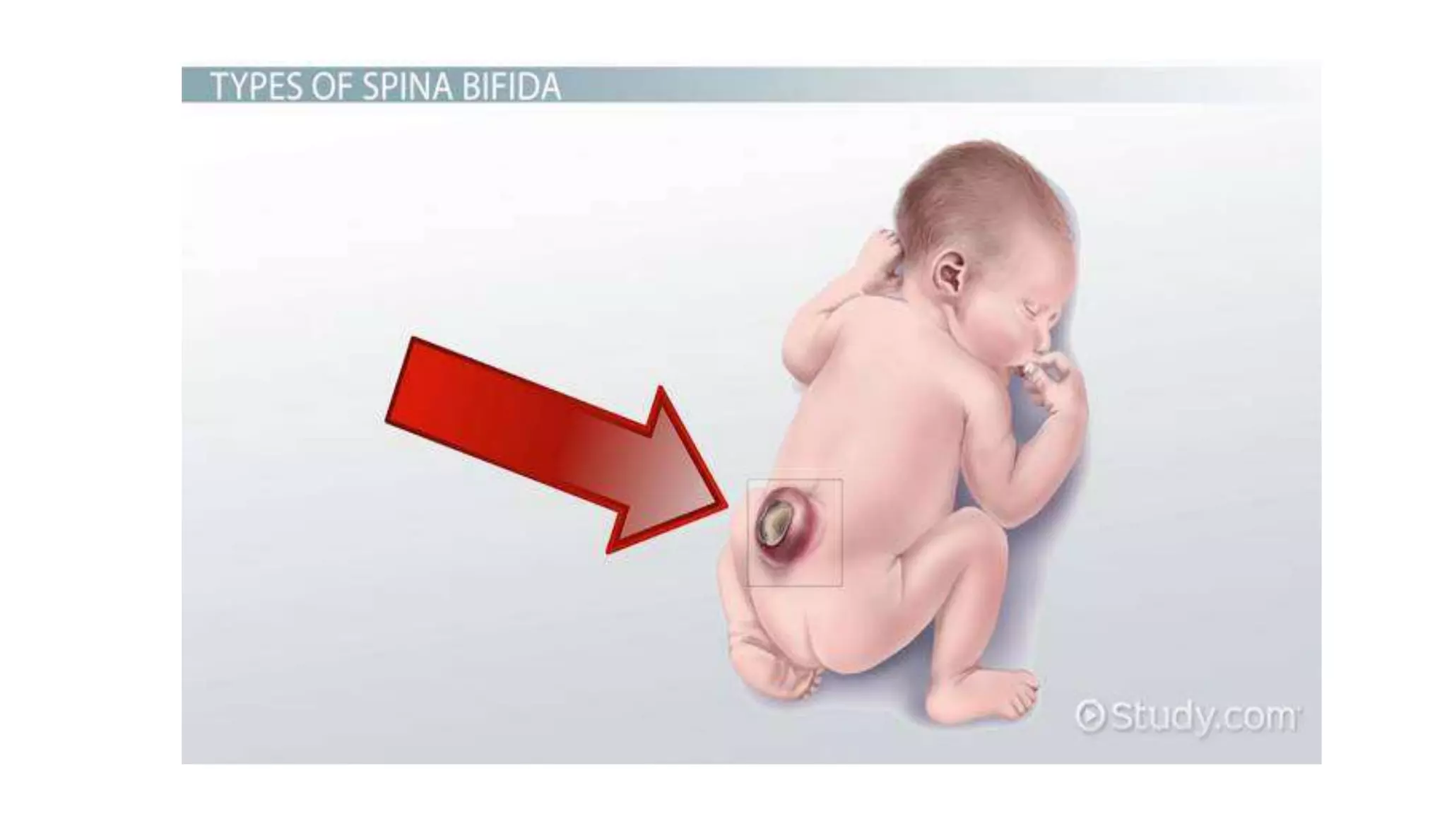 Neutral Defects Neural tube defects (myelomeningocele) | spina bifida | PPTX