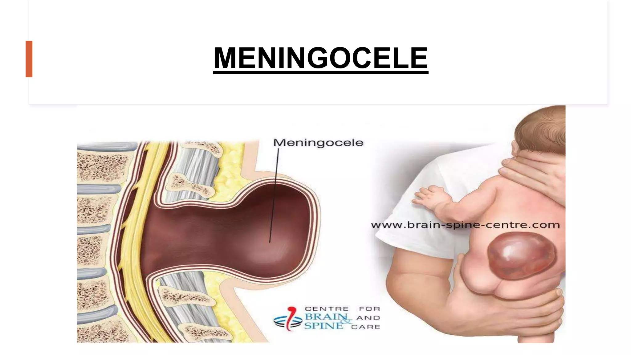 Neutral Defects Neural tube defects (myelomeningocele) | spina bifida | PPTX
