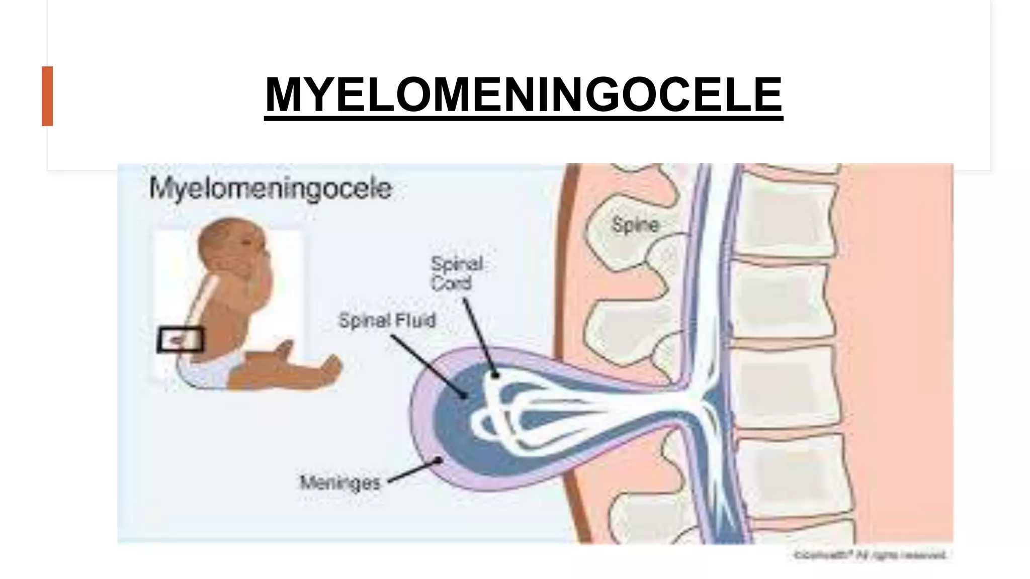 Neutral Defects Neural tube defects (myelomeningocele) | spina bifida | PPT