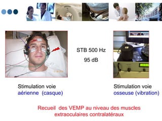 Recueil  des VEMP au niveau des muscles extraoculaires contralatéraux Stimulation voie  aérienne  (casque) Stimulation voie  osseuse (vibration) STB 500 Hz  95 dB 