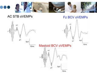 Mastoid BCV oVEMPs AC STB oVEMPs Fz BCV oVEMPs 