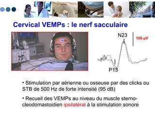 Cervical VEMPs : le nerf sacculaire Stimulation par aérienne ou osseuse par des clicks ou STB de 500 Hz de forte intensité (95 dB) Recueil des VEMPs au niveau du muscle sterno-cleodomastoidien  ipsilatéral  à la stimulation sonore 100 µV P13 N23 
