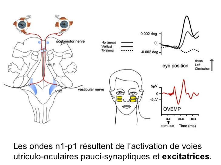 Neurinome de l