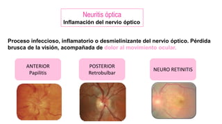 Neuritis optica lo necesario. y todo acerca de l NEUROSIS | PPTX
