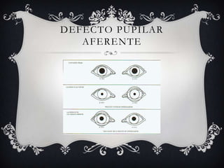 DEFECTO PUPILAR
   AFERENTE
 