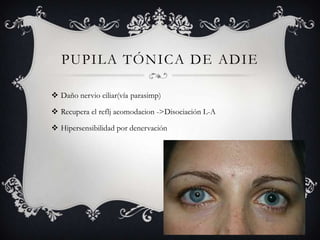 PUPILA TÓNICA DE ADIE

 Daño nervio ciliar(vía parasimp)

 Recupera el reflj acomodacion ->Disociación L-A

 Hipersensibilidad por denervación
 