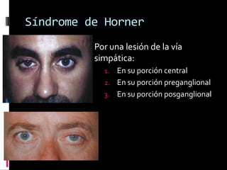 Síndrome de Horner
          Por una lesión de la vía
          simpática:
            1. En su porción central
            2. En su porción preganglional
            3. En su porción posganglional
 