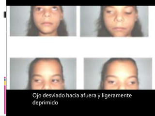 Ojo desviado hacia afuera y ligeramente
deprimido
 