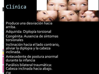 Clínica

 Produce una desviación hacia
  arriba.
 Adquirida: Diplopía torsional
 Congénita: Ausencia de síntomas
  torsionales
 Inclinación hacia el lado contrario,
  aliviar la diplopia y la cabeza
  inclinada.
 Antecedente de postura anormal
  durante la infancia
 Parálisis bilateral traumática:
  Cabeza inclinada hacia abajo.
 