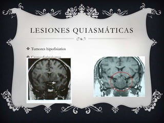 LESIONES QUIASMÁTICAS

 Tumores hipofisiarios

 Craneofaringiomas
 