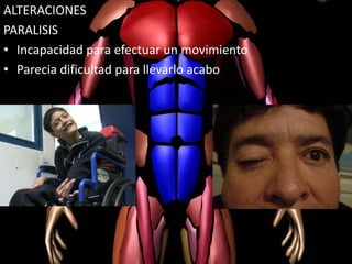 ALTERACIONES
PARALISIS
• Incapacidad para efectuar un movimiento
• Parecia dificultad para llevarlo acabo
 
