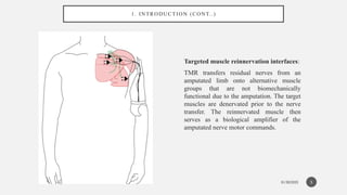 01/30/2025
1. INTRODUCTION (CONT..)
Targeted muscle reinnervation interfaces:
TMR transfers residual nerves from an
amputated limb onto alternative muscle
groups that are not biomechanically
functional due to the amputation. The target
muscles are denervated prior to the nerve
transfer. The reinnervated muscle then
serves as a biological amplifier of the
amputated nerve motor commands.
5
 