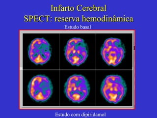 Infarto Cerebral SPECT :   reserva hemodinâmica Estudo basal Estudo com dipiridamol 