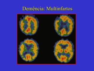 Demência : Multinfartos 