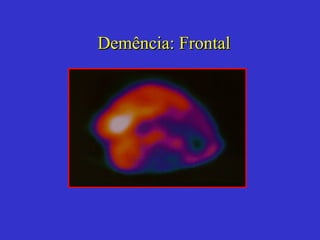 Demência : Frontal 