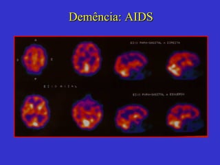 Demência : AIDS 