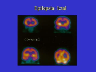 Epilepsia : Ictal 