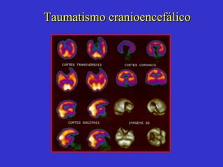 Taumatismo cranioencefálico 