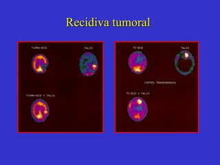 Recidiva tumoral 