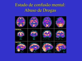 Estado de confusão mental: Abuso de Drogas 
