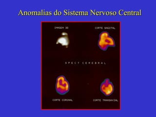 Anomalias do Sistema Nervoso Central 