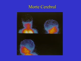 Morte Cerebral 