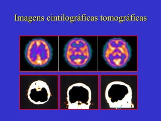 Imagens cintilográficas tomográficas 