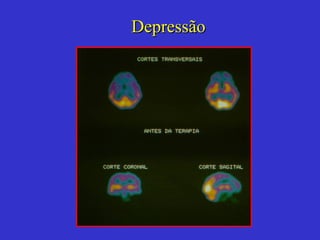 Depressão 