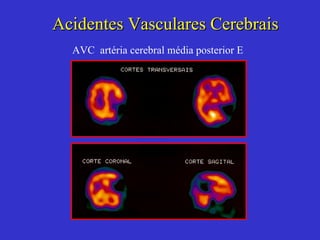 Acidentes Vasculares Cerebrais AVC  artéria cerebral média posterior E 